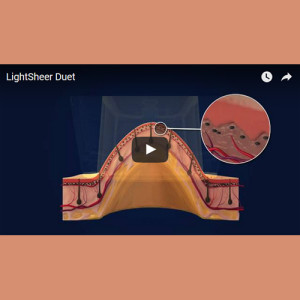 Laser Smooth Company_How does Laser Hair Removal Work